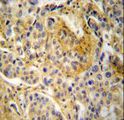 NCF1 / p47phox / p47 phox Antibody - NCF1 Antibody immunohistochemistry of formalin-fixed and paraffin-embedded human lung carcinoma followed by peroxidase-conjugated secondary antibody and DAB staining.