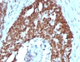 NCL / Nucleolin Antibody - IHC testing of FFPE human ovarian carcinoma with Nucleolin antibody (clone NPC23-2).  This image was taken for the unmodified form of this product. Other forms have not been tested.