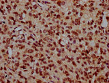 NDC1 / TMEM48 Antibody - Immunohistochemistry Dilution at 1:300 and staining in paraffin-embedded human glioma cancer performed on a Leica BondTM system. After dewaxing and hydration, antigen retrieval was mediated by high pressure in a citrate buffer (pH 6.0). Section was blocked with 10% normal Goat serum 30min at RT. Then primary antibody (1% BSA) was incubated at 4°C overnight. The primary is detected by a biotinylated Secondary antibody and visualized using an HRP conjugated SP system.