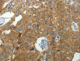 NDRG2 Antibody - Immunohistochemistry of paraffin-embedded Human ovarian cancer using NDRG2 Polyclonal Antibody at dilution of 1:40.