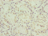 NDUFA12 / B17.2 Antibody - Immunohistochemistry of paraffin-embedded human gastric cancer at dilution of 1:100
