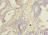 NDUFA13 / GRIM19 Antibody - Immunohistochemistry of paraffin-embedded human prostate cancer at dilution 1:100