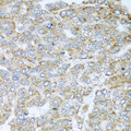 NDUFA2 Antibody - Immunohistochemistry of paraffin-embedded human liver cancer tissue.