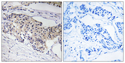 NDUFA3 / B9 Antibody - Immunohistochemistry analysis of paraffin-embedded human breast carcinoma tissue, using NDUFA3 Antibody. The picture on the right is blocked with the synthesized peptide.