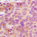 NDUFA3 / B9 Antibody - Immunohistochemical analysis of NDUFA3 staining in human breast cancer formalin fixed paraffin embedded tissue section. The section was pre-treated using heat mediated antigen retrieval with sodium citrate buffer (pH 6.0). The section was then incubated with the antibody at room temperature and detected using an HRP conjugated compact polymer system. DAB was used as the chromogen. The section was then counterstained with hematoxylin and mounted with DPX.