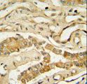 NDUFAF3 Antibody - NDUF3 antibody immunohistochemistry of formalin-fixed and paraffin-embedded human lung tissue followed by peroxidase-conjugated secondary antibody and DAB staining.