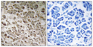 NDUFB1 / MNLL Antibody - Immunohistochemistry analysis of paraffin-embedded human pancreas, using NDUFB1 Antibody. The picture on the right is blocked with the synthesized peptide.