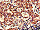 NDUFB6 Antibody - Immunohistochemistry of paraffin-embedded human lung cancer using NDUFB6 Antibody at dilution of 1:100