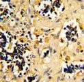 NDUFS4 Antibody - Formalin-fixed and paraffin-embedded human kidney carcinoma reacted with NDUFS4 Antibody , which was peroxidase-conjugated to the secondary antibody, followed by DAB staining. This data demonstrates the use of this antibody for immunohistochemistry; clinical relevance has not been evaluated.