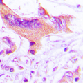 NECAB3 Antibody - Immunohistochemical analysis of NIP1 staining in human lung cancer formalin fixed paraffin embedded tissue section. The section was pre-treated using heat mediated antigen retrieval with sodium citrate buffer (pH 6.0). The section was then incubated with the antibody at room temperature and detected using an HRP conjugated compact polymer system. DAB was used as the chromogen. The section was then counterstained with hematoxylin and mounted with DPX.