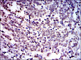 NEDD8 Antibody - IHC of paraffin-embedded cervical cancer tissues using NEDD8 mouse monoclonal antibody with DAB staining.