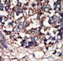 NEK9 Antibody - Formalin-fixed and paraffin-embedded human cancer tissue reacted with the primary antibody, which was peroxidase-conjugated to the secondary antibody, followed by AEC staining. This data demonstrates the use of this antibody for immunohistochemistry; clinical relevance has not been evaluated. BC = breast carcinoma; HC = hepatocarcinoma.