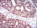 NELFA / WHSC2 Antibody - IHC of paraffin-embedded ovarian cancer tissues using WHSC2 mouse monoclonal antibody with DAB staining.