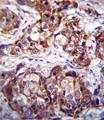 NEP / DDR1 Antibody - DDR1 Antibody immunohistochemistry of formalin-fixed and paraffin-embedded human breast carcinoma followed by peroxidase-conjugated secondary antibody and DAB staining.