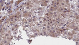 Neurofascin / NF Antibody - 1:100 staining human liver carcinoma tissues by IHC-P. The sample was formaldehyde fixed and a heat mediated antigen retrieval step in citrate buffer was performed. The sample was then blocked and incubated with the antibody for 1.5 hours at 22°C. An HRP conjugated goat anti-rabbit antibody was used as the secondary.