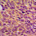 Neurofibromin / NF1 Antibody - Immunohistochemical analysis of NF1 staining in human breast cancer formalin fixed paraffin embedded tissue section. The section was pre-treated using heat mediated antigen retrieval with sodium citrate buffer (pH 6.0). The section was then incubated with the antibody at room temperature and detected using an HRP conjugated compact polymer system. DAB was used as the chromogen. The section was then counterstained with hematoxylin and mounted with DPX.