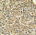NF2 / Merlin Antibody - Merlin Antibody IHC of formalin-fixed and paraffin-embedded human lung carcinoma followed by peroxidase-conjugated secondary antibody and DAB staining.