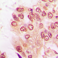 NFKB1 / NF-Kappa-B Antibody - Immunohistochemical analysis of NF-kappaB p105 (pS907) staining in human lung cancer formalin fixed paraffin embedded tissue section. The section was pre-treated using heat mediated antigen retrieval with sodium citrate buffer (pH 6.0). The section was then incubated with the antibody at room temperature and detected using an HRP conjugated compact polymer system. DAB was used as the chromogen. The section was then counterstained with hematoxylin and mounted with DPX.