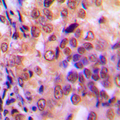 NFKB1 / NF-Kappa-B Antibody - Immunohistochemical analysis of NF-kappaB p105/p50 staining in human prostate cancer formalin fixed paraffin embedded tissue section. The section was pre-treated using heat mediated antigen retrieval with sodium citrate buffer (pH 6.0). The section was then incubated with the antibody at room temperature and detected using an HRP conjugated compact polymer system. DAB was used as the chromogen. The section was then counterstained with hematoxylin and mounted with DPX.