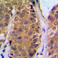 NFKB1 / NF-Kappa-B Antibody - Immunohistochemical analysis of NF-kappaB p105 (pS927) staining in human breast cancer formalin fixed paraffin embedded tissue section. The section was pre-treated using heat mediated antigen retrieval with sodium citrate buffer (pH 6.0). The section was then incubated with the antibody at room temperature and detected using an HRP conjugated compact polymer system. DAB was used as the chromogen. The section was then counterstained with hematoxylin and mounted with DPX.