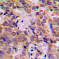 NFKB1 / NF-Kappa-B Antibody - Immunohistochemical analysis of NF-kappaB p105 (pS932) staining in human breast cancer formalin fixed paraffin embedded tissue section. The section was pre-treated using heat mediated antigen retrieval with sodium citrate buffer (pH 6.0). The section was then incubated with the antibody at room temperature and detected using an HRP conjugated compact polymer system. DAB was used as the chromogen. The section was then counterstained with hematoxylin and mounted with DPX.