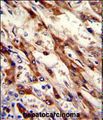 NFKB2 Antibody - Formalin-fixed and paraffin-embedded human hepatocarcinoma with MOUSE NFKB2 Antibody (N-term), which was peroxidase-conjugated to the secondary antibody, followed by DAB staining.