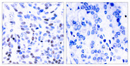NFKB2 Antibody - Immunohistochemistry analysis of paraffin-embedded human breast carcinoma tissue, using NF-kappaB p100/p52 Antibody. The picture on the right is blocked with the synthesized peptide.