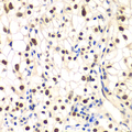 NFKBIB / IKB Beta / IKBB Antibody - Immunohistochemistry of paraffin-embedded human kidney cancer tissue.