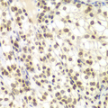 NIRF / UHRF2 Antibody - Immunohistochemistry of paraffin-embedded human kidney cancer tissue.