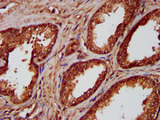 NKX2-8 Antibody - Immunohistochemistry image at a dilution of 1:300 and staining in paraffin-embedded human prostate cancer performed on a Leica BondTM system. After dewaxing and hydration, antigen retrieval was mediated by high pressure in a citrate buffer (pH 6.0) . Section was blocked with 10% normal goat serum 30min at RT. Then primary antibody (1% BSA) was incubated at 4 °C overnight. The primary is detected by a biotinylated secondary antibody and visualized using an HRP conjugated SP system.