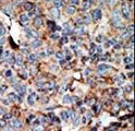NME2 Antibody - Formalin-fixed and paraffin-embedded human cancer tissue reacted with the primary antibody, which was peroxidase-conjugated to the secondary antibody, followed by AEC staining. This data demonstrates the use of this antibody for immunohistochemistry; clinical relevance has not been evaluated. BC = breast carcinoma; HC = hepatocarcinoma.