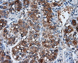 NME4 Antibody - IHC of paraffin-embedded Carcinoma of liver tissue using anti-NME4 mouse monoclonal antibody. (Dilution 1:50).