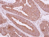 NME9 / TXNDC6 Antibody - IHC of paraffin-embedded Colon ca, using TXNDC6 antibody at 1:500 dilution.