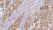 NMU / Neuromedin U Antibody - 1:100 staining human Melanoma tissue by IHC-P. The sample was formaldehyde fixed and a heat mediated antigen retrieval step in citrate buffer was performed. The sample was then blocked and incubated with the antibody for 1.5 hours at 22°C. An HRP conjugated goat anti-rabbit antibody was used as the secondary.