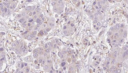 NMUR2 Antibody - 1:100 staining human liver carcinoma tissues by IHC-P. The sample was formaldehyde fixed and a heat mediated antigen retrieval step in citrate buffer was performed. The sample was then blocked and incubated with the antibody for 1.5 hours at 22°C. An HRP conjugated goat anti-rabbit antibody was used as the secondary.