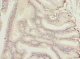 NOL6 / NRAP Antibody - Immunohistochemistry of paraffin-embedded human prostate cancer using antibody at dilution of 1:100.