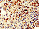 NOLA2 Antibody - Immunohistochemistry of paraffin-embedded human melanoma using NHP2 Antibody at dilution of 1:100