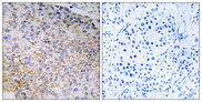 NOX3 Antibody - Immunohistochemistry analysis of paraffin-embedded human breast carcinoma tissue, using NOX3 Antibody. The picture on the right is blocked with the synthesized peptide.