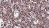 NPBWR2 / GPR8 Antibody - 1:100 staining human liver carcinoma tissues by IHC-P. The sample was formaldehyde fixed and a heat mediated antigen retrieval step in citrate buffer was performed. The sample was then blocked and incubated with the antibody for 1.5 hours at 22°C. An HRP conjugated goat anti-rabbit antibody was used as the secondary.