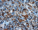 NPR3 Antibody - Immunohistochemical staining of paraffin-embedded Carcinoma of thyroid tissue using anti- mouse monoclonal antibody. (Dilution 1:50).