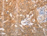 NQO1 Antibody - Immunohistochemistry of paraffin-embedded Human ovarian cancer using NQO1 Polyclonal Antibody at dilution of 1:25.