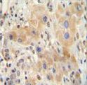 NR0B2 Antibody - NR0B2 antibody immunohistochemistry of formalin-fixed and paraffin-embedded human hepatocarcinoma followed by peroxidase-conjugated secondary antibody and DAB staining.