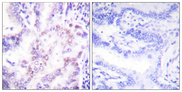 NR1A2 / THRB Antibody - Immunohistochemistry analysis of paraffin-embedded human lung carcinoma tissue, using Thyroid Hormone Receptor beta Antibody. The picture on the right is blocked with the synthesized peptide.