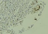 NR1H2 / LXR Beta Antibody - 1:100 staining human breast carcinoma tissue by IHC-P. The sample was formaldehyde fixed and a heat mediated antigen retrieval step in citrate buffer was performed. The sample was then blocked and incubated with the antibody for 1.5 hours at 22°C. An HRP conjugated goat anti-rabbit antibody was used as the secondary.