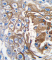 NRAS / N-ras Antibody - Formalin-fixed and paraffin-embedded human lung carcinoma tissue reacted with NRAS antibody , which was peroxidase-conjugated to the secondary antibody, followed by DAB staining. This data demonstrates the use of this antibody for immunohistochemistry; clinical relevance has not been evaluated.