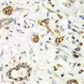 NRBF2 Antibody - Immunohistochemistry of paraffin-embedded human liver cancer tissue.
