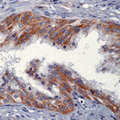 NRG1 / Heregulin / Neuregulin Antibody - Formalin-fixed, paraffin-embedded human prostate carcinoma stained with peroxidase-conjugate and DAB chromogen. Note cytoplasmic staining of tumor cells.  This image was taken for the unmodified form of this product. Other forms have not been tested.