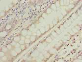 NSUN7 Antibody - Immunohistochemistry of paraffin-embedded human colon cancer using antibody at dilution of 1:100.