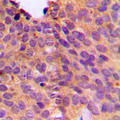 NT5C1B Antibody - Immunohistochemical analysis of NT5C1B staining in human breast cancer formalin fixed paraffin embedded tissue section. The section was pre-treated using heat mediated antigen retrieval with sodium citrate buffer (pH 6.0). The section was then incubated with the antibody at room temperature and detected using an HRP conjugated compact polymer system. DAB was used as the chromogen. The section was then counterstained with hematoxylin and mounted with DPX.
