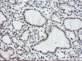 NUB1 Antibody - IHC of paraffin-embedded Carcinoma of Human thyroid tissue using anti-NUB1 mouse monoclonal antibody.